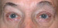 ptosis_post2