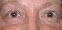 ptosis_post3