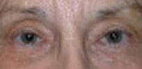 ptosis_post4